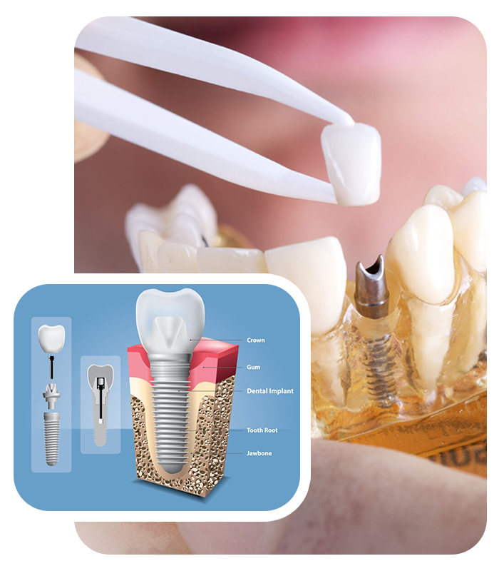 dental implants in prince rupert, bc dental implants in prince rupert, bc