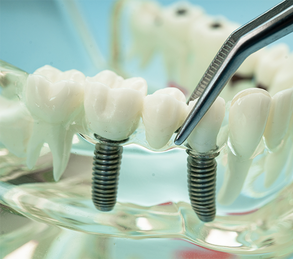 Dental Implants in Prince Rupert