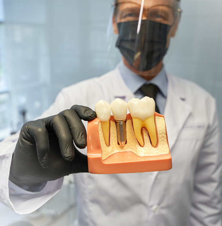 tooth-implants