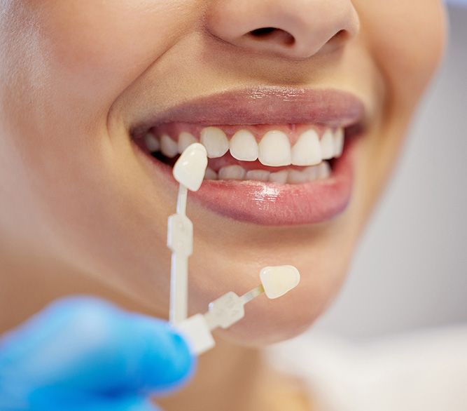 Dental Veneers in Prince Rupert | Enhance Your Smile ✅