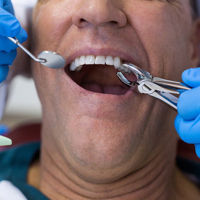 Wisdom Teeth extraction Prince Rupert Wisdom Teeth extraction Prince Rupert